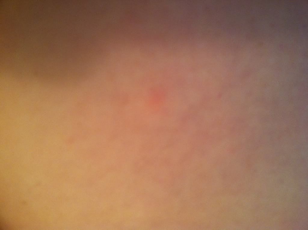 Here are a few pictures. The larger welts are going down more now and ...